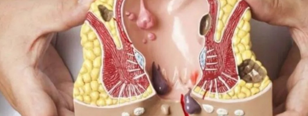 كل ما تريد معرفته عن البواسير وافضل كريم لعلاجها