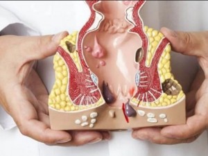 كل ما تريد معرفته عن البواسير وافضل كريم لعلاجها