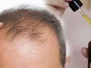 دليل شامل عن علاج تساقط الشعر