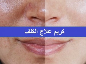 كريم علاج الكلف حل ثوري في عالم التجميل